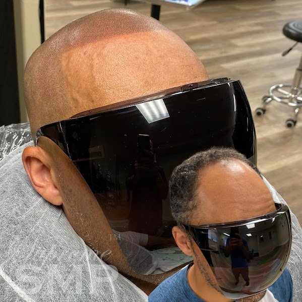 Boston Scalp Micropigmentation Results