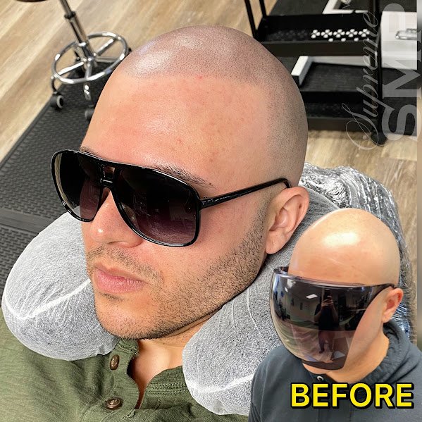 Scalp Micropigmentation Boston